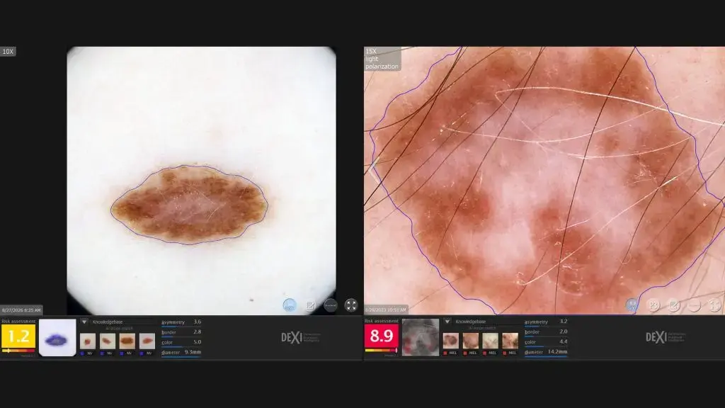 AI Tool Assists Dermatologists in Assessing Skin Cancer Risk