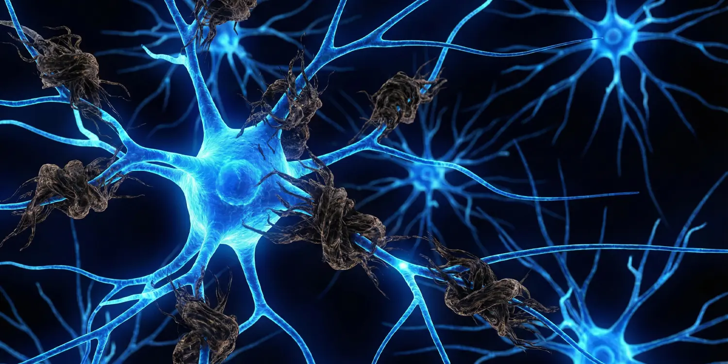 Brain scans reveal tau buildup in nearly two-thirds of late-onset psychosis patients